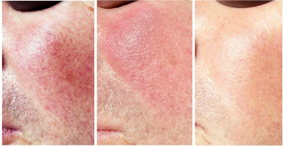 Couperose Behandlung Basel – Beauty Laser Clinic